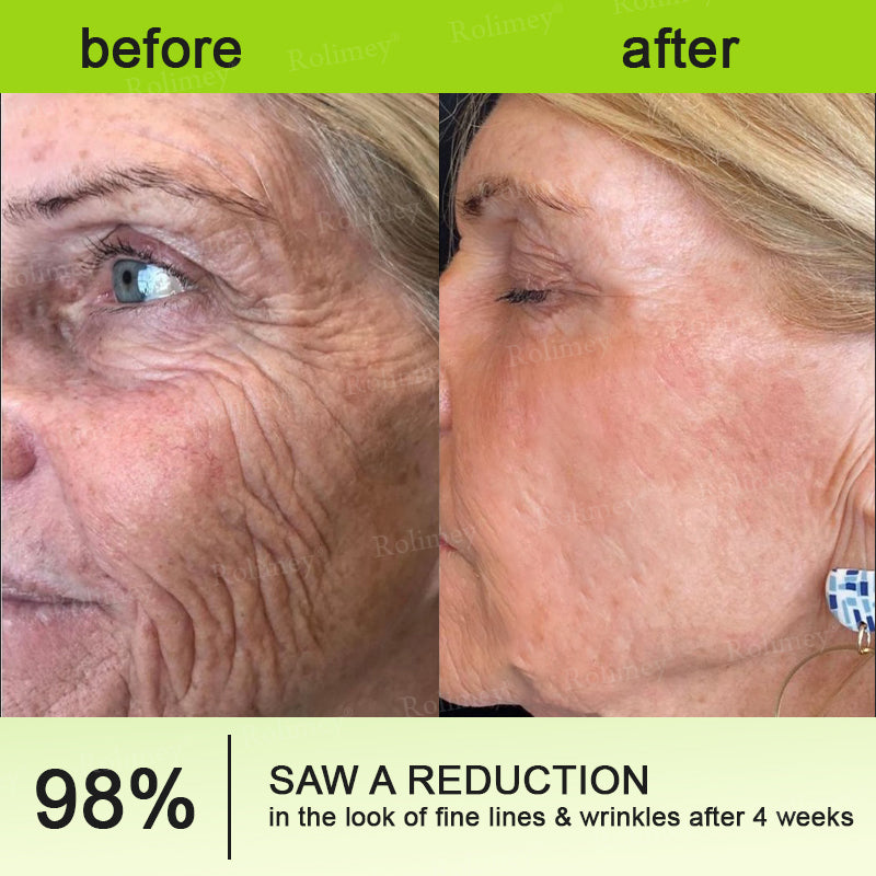 💫 Botox & Vita-A Retinol Shot Wrinkle-Lift Tightening cream - Last Day Promotion 70% OFF