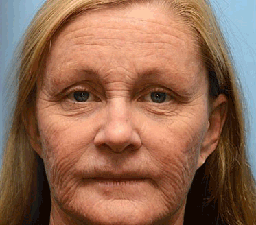 💫 Botox & Vita-A Retinol Shot Wrinkle-Lift Tightening cream - Last Day Promotion 70% OFF